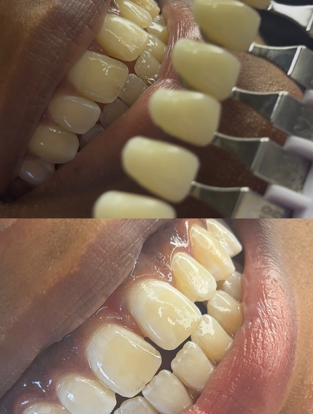 Kleurenkaart naast de tanden na whitening